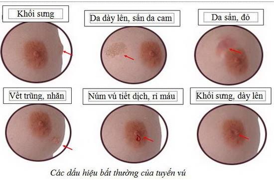 Dấu hiệu bất thường của vú Dấu hiệu bất thường của vú